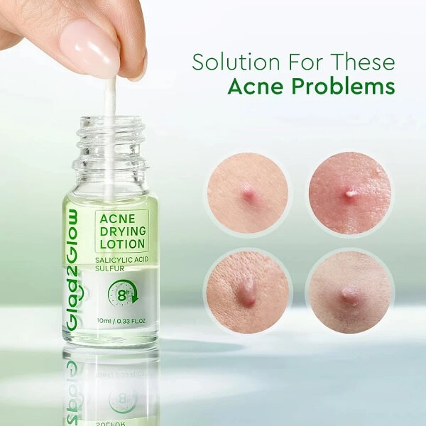 Glad2Glow Acne Drying Lotion