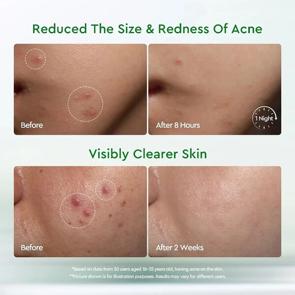 Glad2Glow Acne Drying Lotion - Image 5
